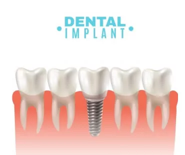 How Dental Implants Can Preserve Bone