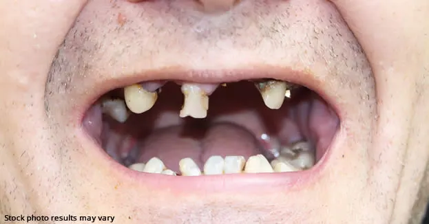 Are you a candidate for a full mouth restoration?