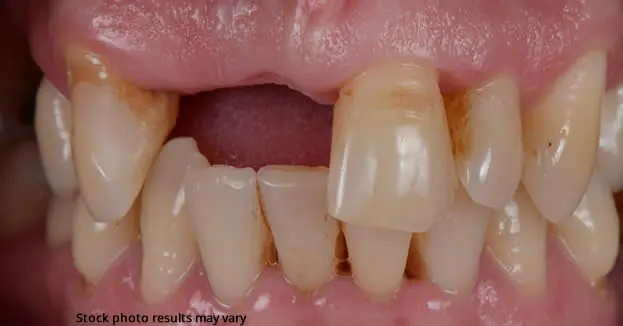What Types of Dental Bridges Are Available?