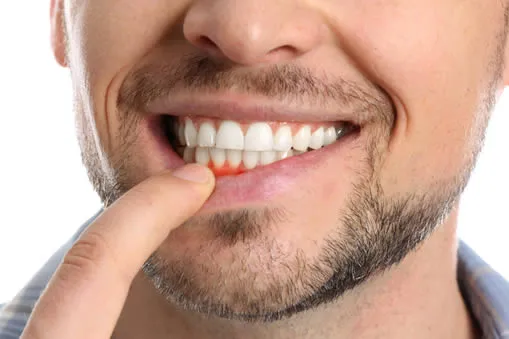 What are the symptoms or signs of gum disease?