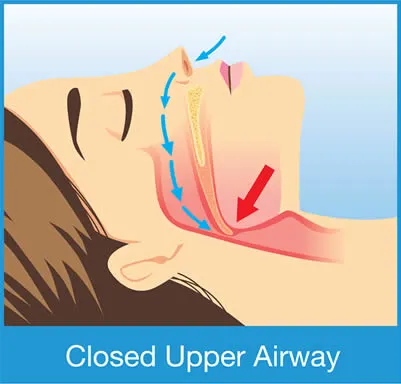 Closed Upper Airway