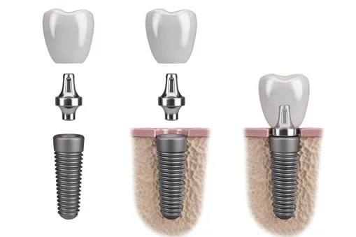 Dental implant stages diagram