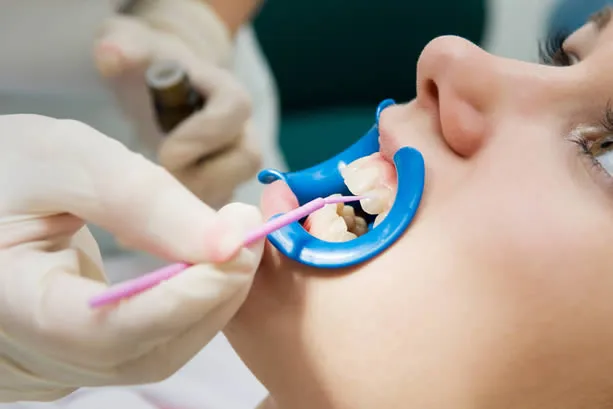 Dental sealant applied to teeth