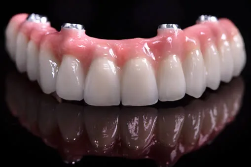 Implant supported denture