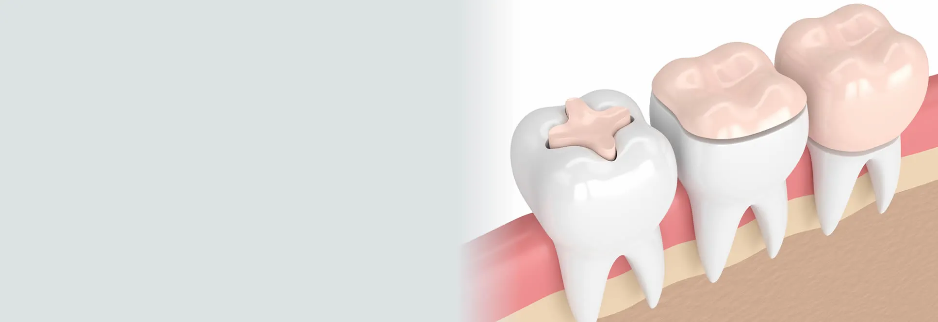 Dental inlays and onlays