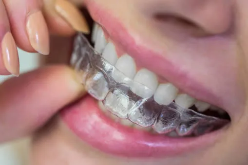 What Exactly is Invisalign®?