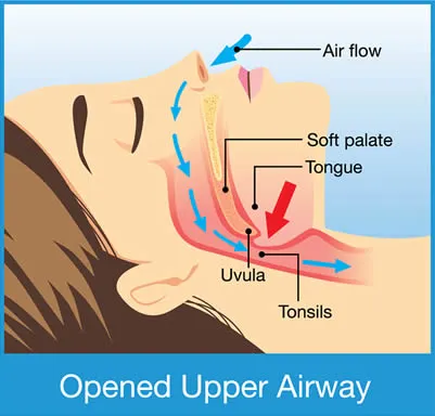 Opened Upper Airway