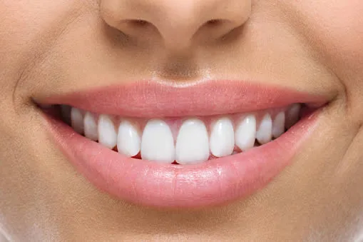 Perfect smile after gum lift procedure