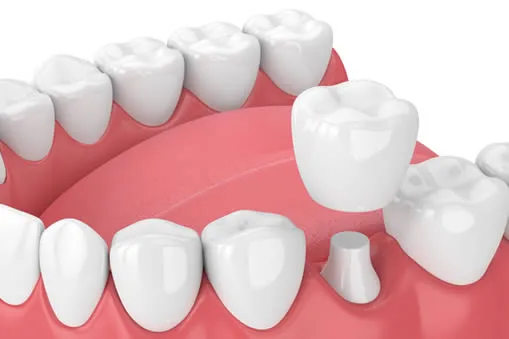 Dental crowns and bridges at Allure Family Dental & Specialty Group Huntington Beach