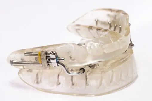 Sleep apnea oral appliance mouthguard