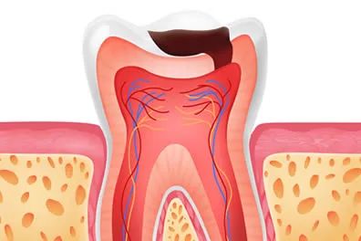 What is a cavity?