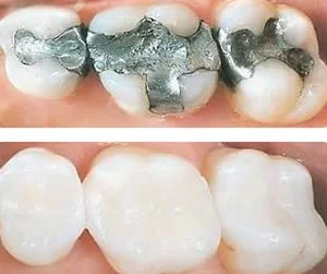What are composite fillings?