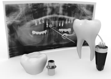 Dental Implants Are the Future