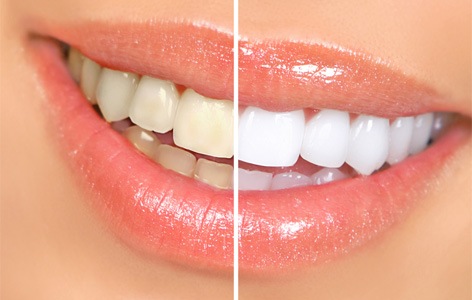 teeth-whitening-4