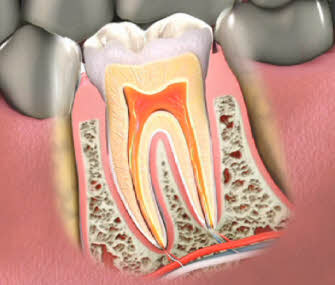 The Truth About Root Canal Therapy