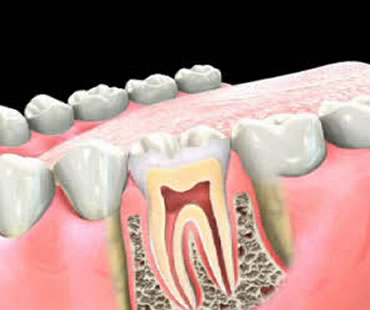 Can Root Canal Treatment Fail?