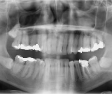 The Value of Dental X-rays
