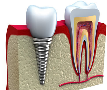 dental implants dentist in Huntington Beach