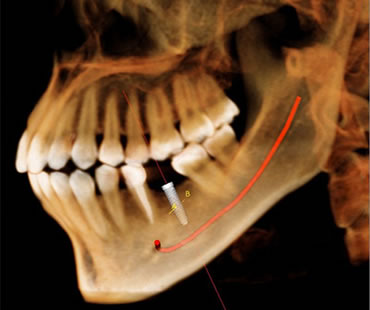 Dental implants Huntington Beach