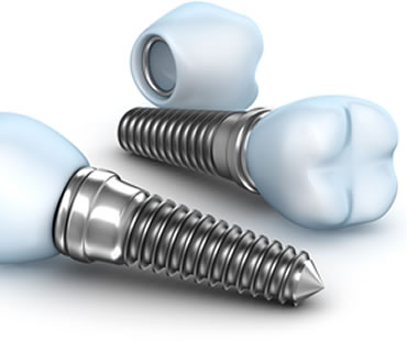 Implant dentist in Huntington Beach