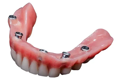 Snap in dentures