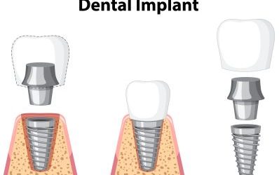 Small but Mighty: When Mini Dental Implants are the Right Choice for You