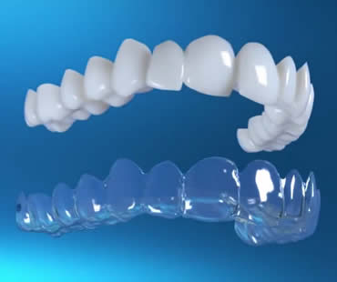 Frequently Asked Questions About Invisalign