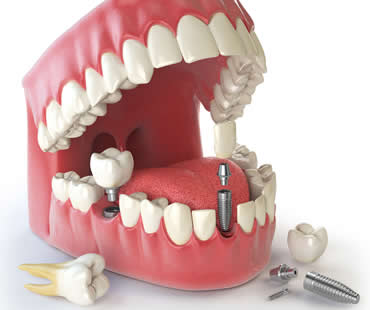 Benefits of Dental Implants